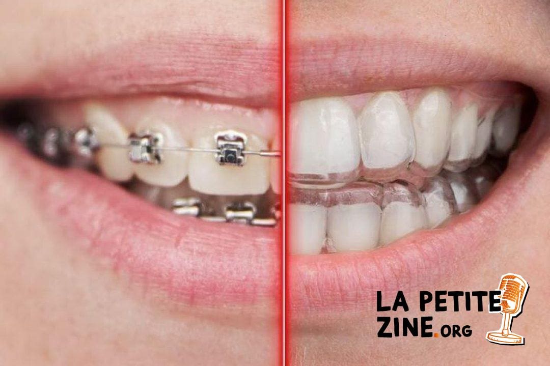 Comment la gouttière dentaire révolutionne-t-elle le monde de l’orthodontie moderne ?